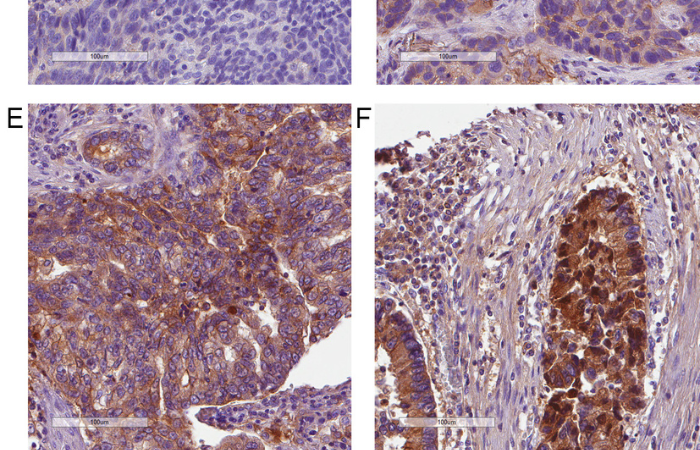 Publikacja nt. podwyższonej ekspresji czynnika dopełniacza I w komórkach raka płuc